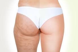 Get rid of unwanted cellulite 