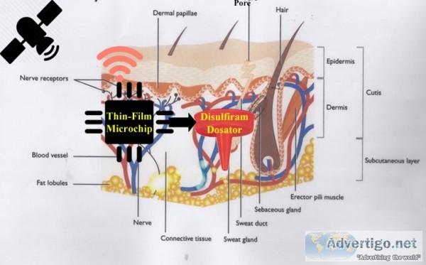Esperal implant for alcohol addiction