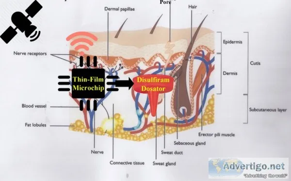 Esperal implant for alcohol addiction