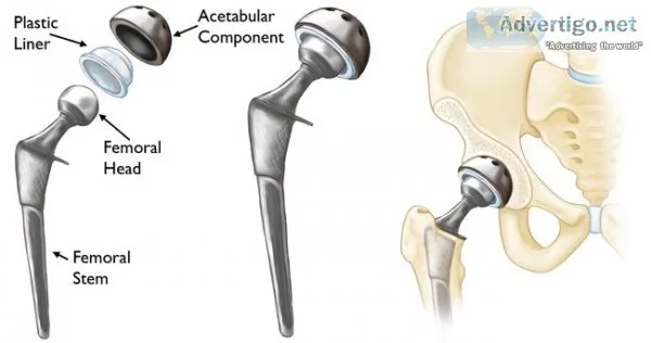 Get total hip replacement surgery at jai