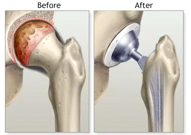 Get total hip replacement surgery at jai