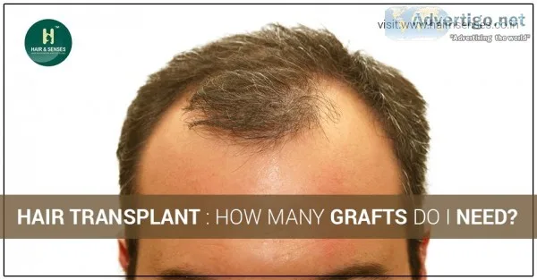 Affordable hair transplant in india