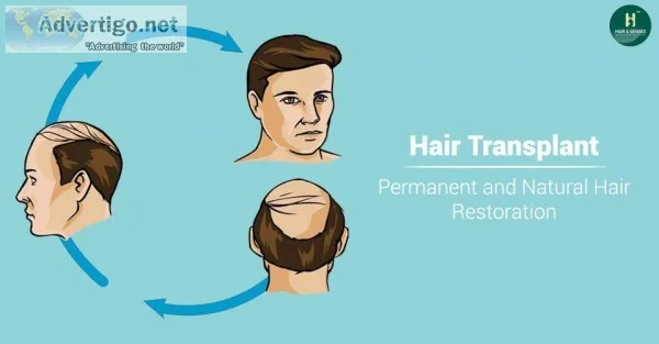 Affordable hair transplant in india