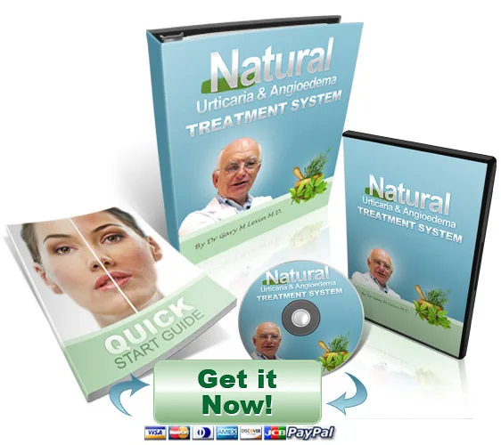 Get rid-of your hives naturally