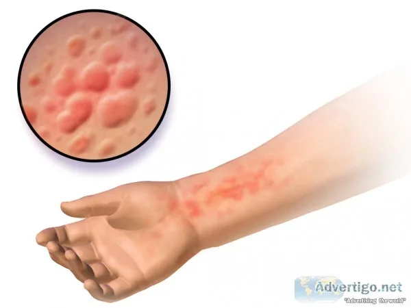 Get rid-of your hives naturally