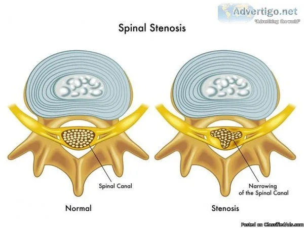 Do you know about Spinal Stenosis Surgery