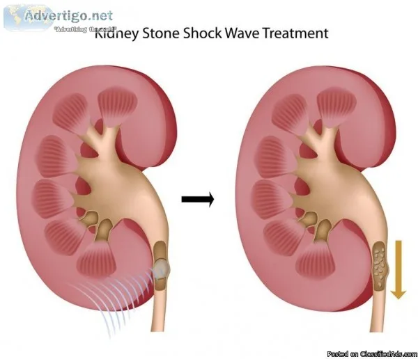 Shockwave Lithotripsy (ESWL)