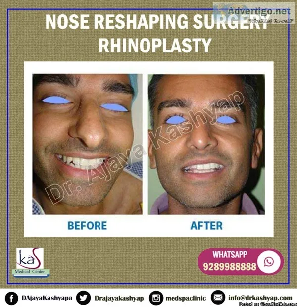 Are You A Good Candidate for Rhinoplasty Surgery