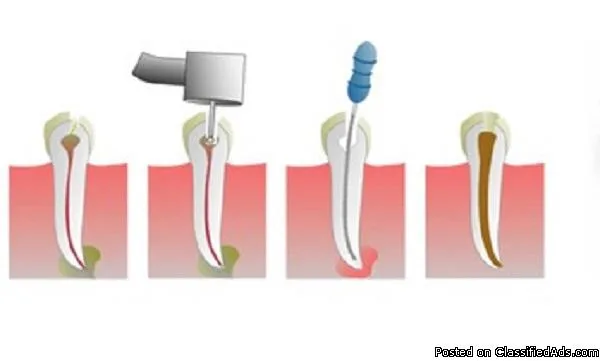Save Your Badly Decayed or Infected Tooth With Root Canal
