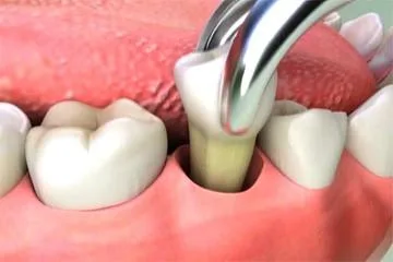 Effective Treatment for Wisdom Teeth Removal