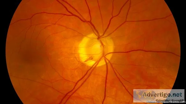 Optic Nerve Transplant Stem Cell