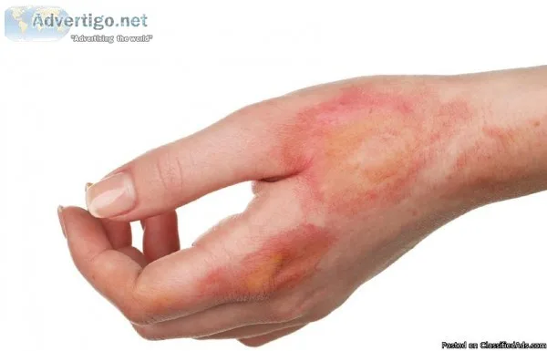 Burn Rehabilitation in Chennai  JH Rehabilitation