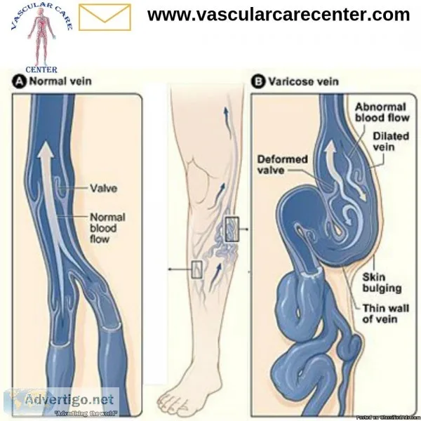 Varicose Veins Treatment In Hyderabad  Vascular Care Center