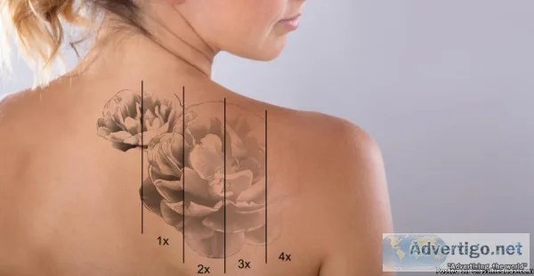 Tattoo Removal in Paschim vihar