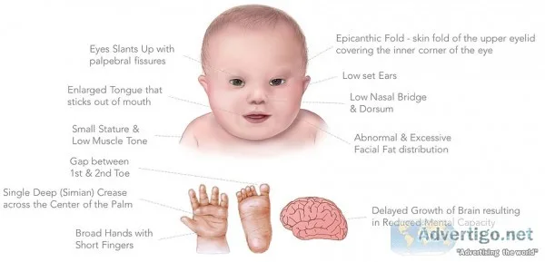 Doctors for down s syndrome in jaipur 