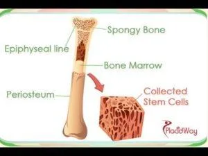 Bone Marrow Transplant Treatment in India - Health and Hopes