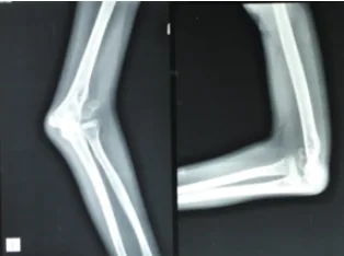 Treatment of neglected femoral neck fracture