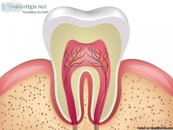 Affordable Root Canal Treatment in Delhi