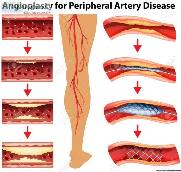 Angioplasty in Mumbai (with Cost) -medicaltreatmentcos t.com
