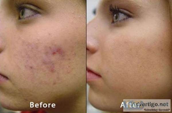 Microdermabrasion