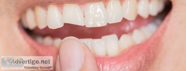 Three Ways to Get a Chipped Tooth Fixed