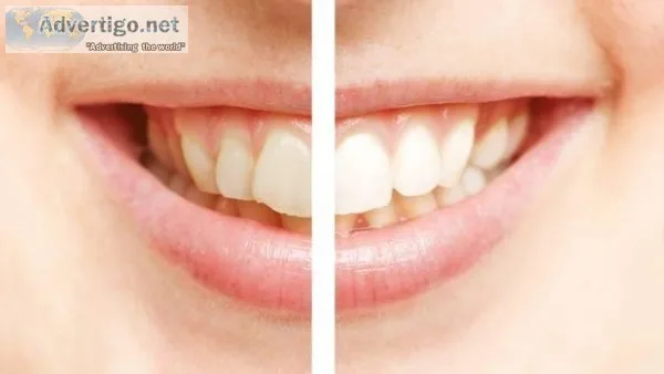 Cosmetic Teeth Whitening Products in Auckland
