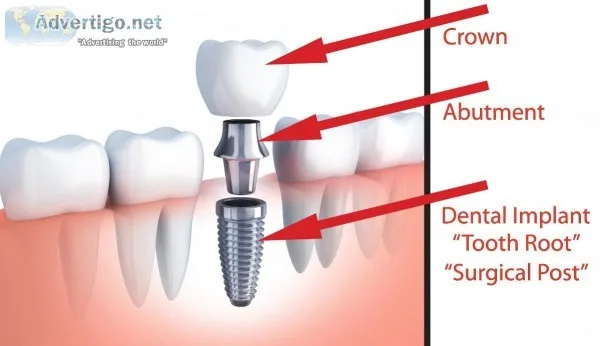 Looking for Dental Implants Treatment Burbank City California