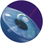 Fast Smile Vision Surgery