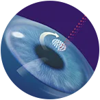 Fast Smile Vision Surgery