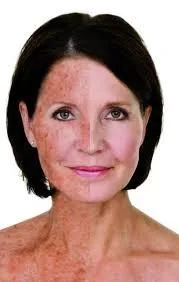 Sun Damage Toronto