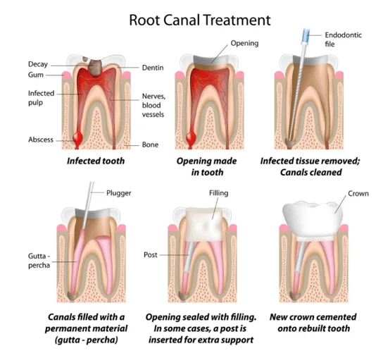 Root Canal Dentist in Pune