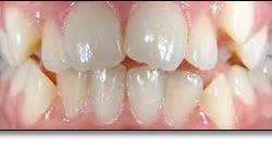 Invisalign Treatment in Waterloo by Eastbridge Dental Care
