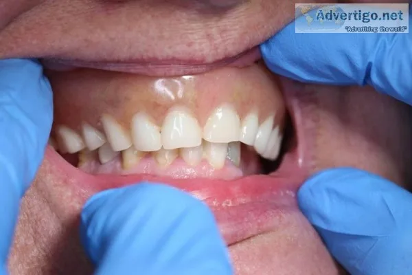 All on 4 dental implants services in las vegasABC DENTAL