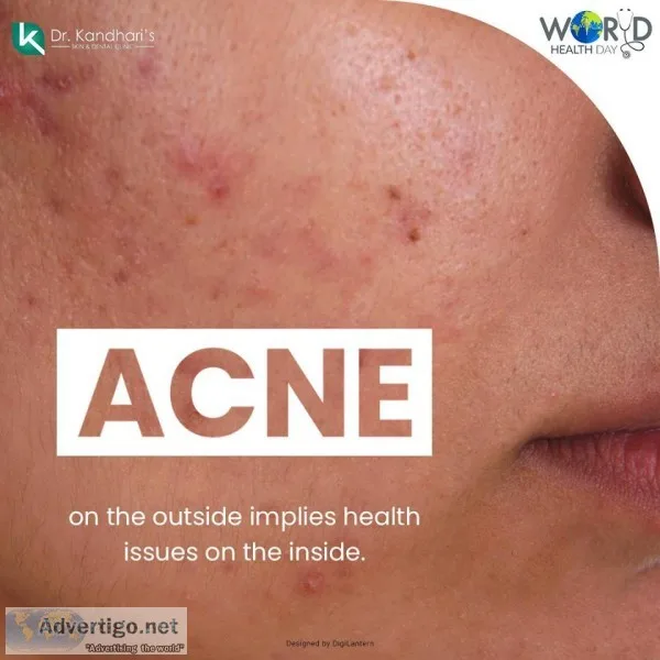 Acne Treatment in Delhi by Specialist