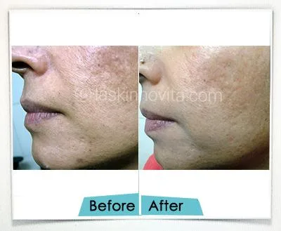 Aesthetic Treatment in Gurgaon