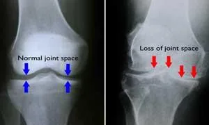 Best Knee Surgeon in Delhi NCR