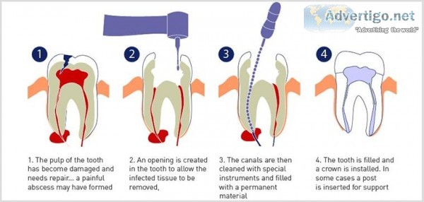 Root Canal Treatment in Gurgaon