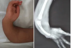 What causes radial club hand