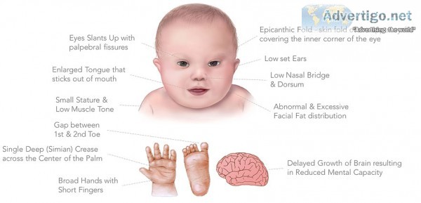 Doctors for down s syndrome in delhi