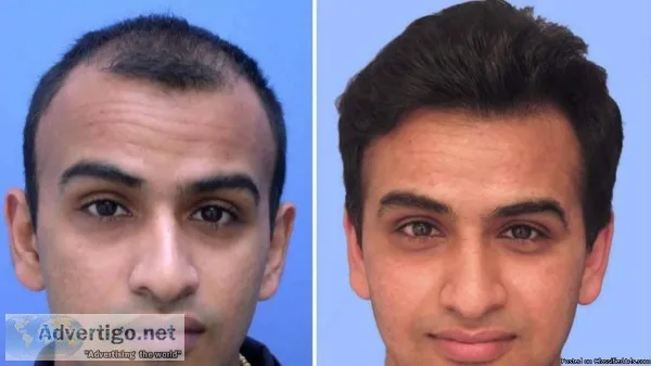 Hair Transplantation in India  Sage Hair