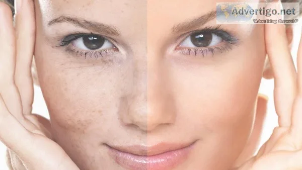 Skin Pigmentation Causes and Treatment