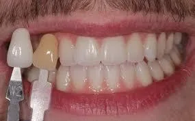 Teeth Whitening in Gurgaon  Teeth bleaching in Gurgaon