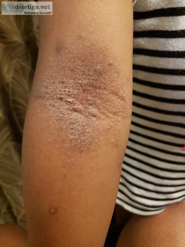 Eczema