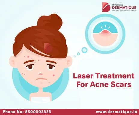 Best Laser treatment for acne scars in Hyderabad