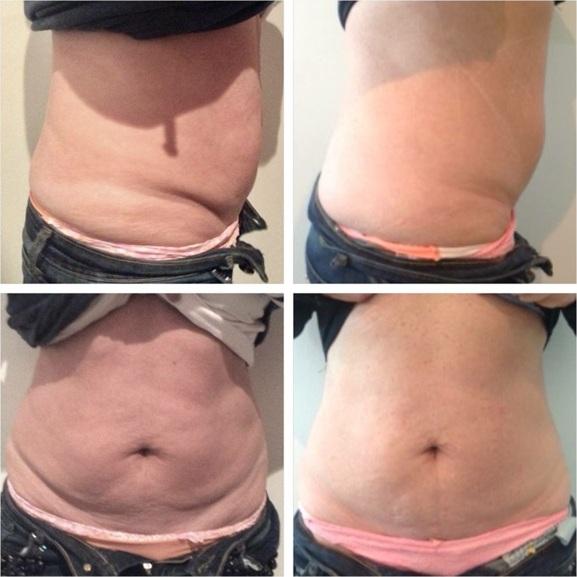 Weight Loss Treatment In Chennai