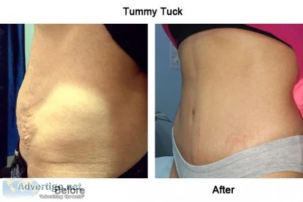 Skin Tightening Treatment In Chennai