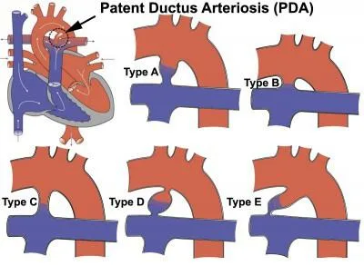 PDA Device Closure procedure in India  Healing Touristry