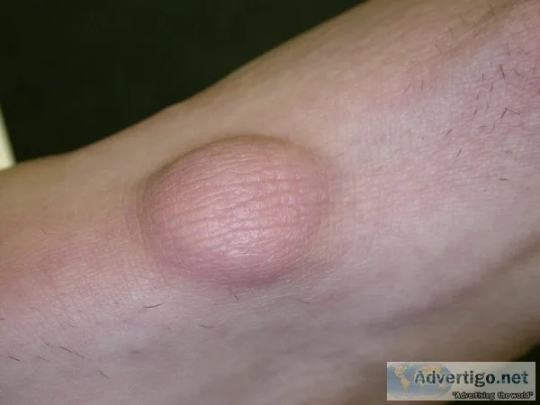 Lipoma Treatment Without Surgery - Lipoma Wand