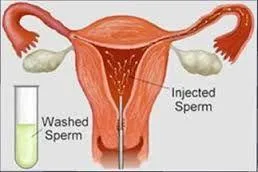 IUI Procedure