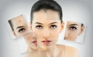 Acne Treatment